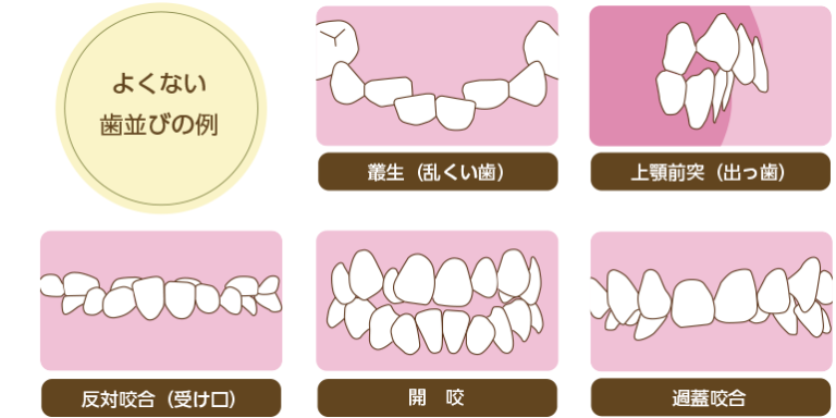 顎顔面矯正